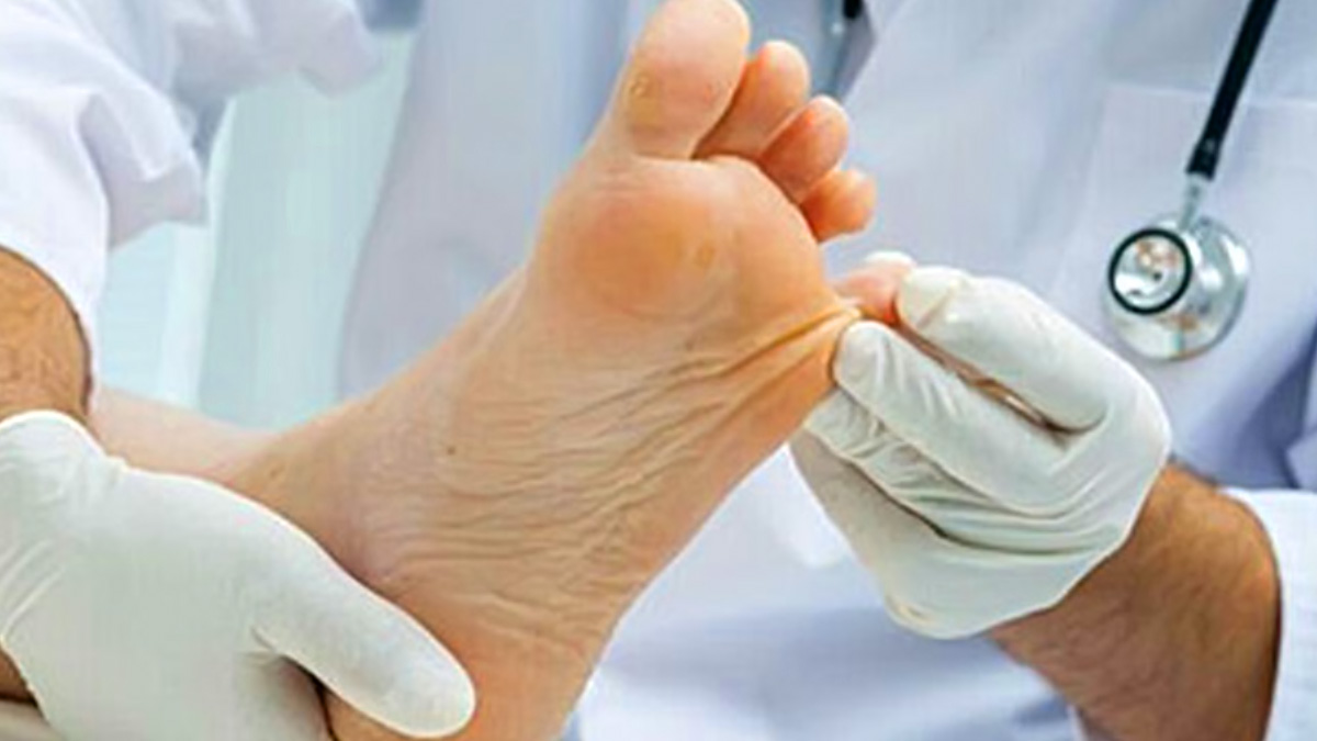 干細胞治療糖尿病足的臨床效果研究