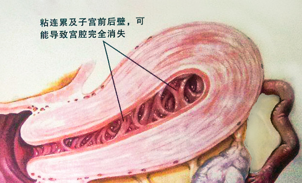 干細胞的4大作用，幫助修復宮腔粘連所致的子宮內(nèi)膜損傷