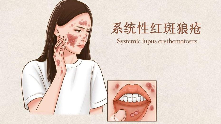 案例 | 干細(xì)胞移植治療1例重癥紅斑狼瘡的研究報告