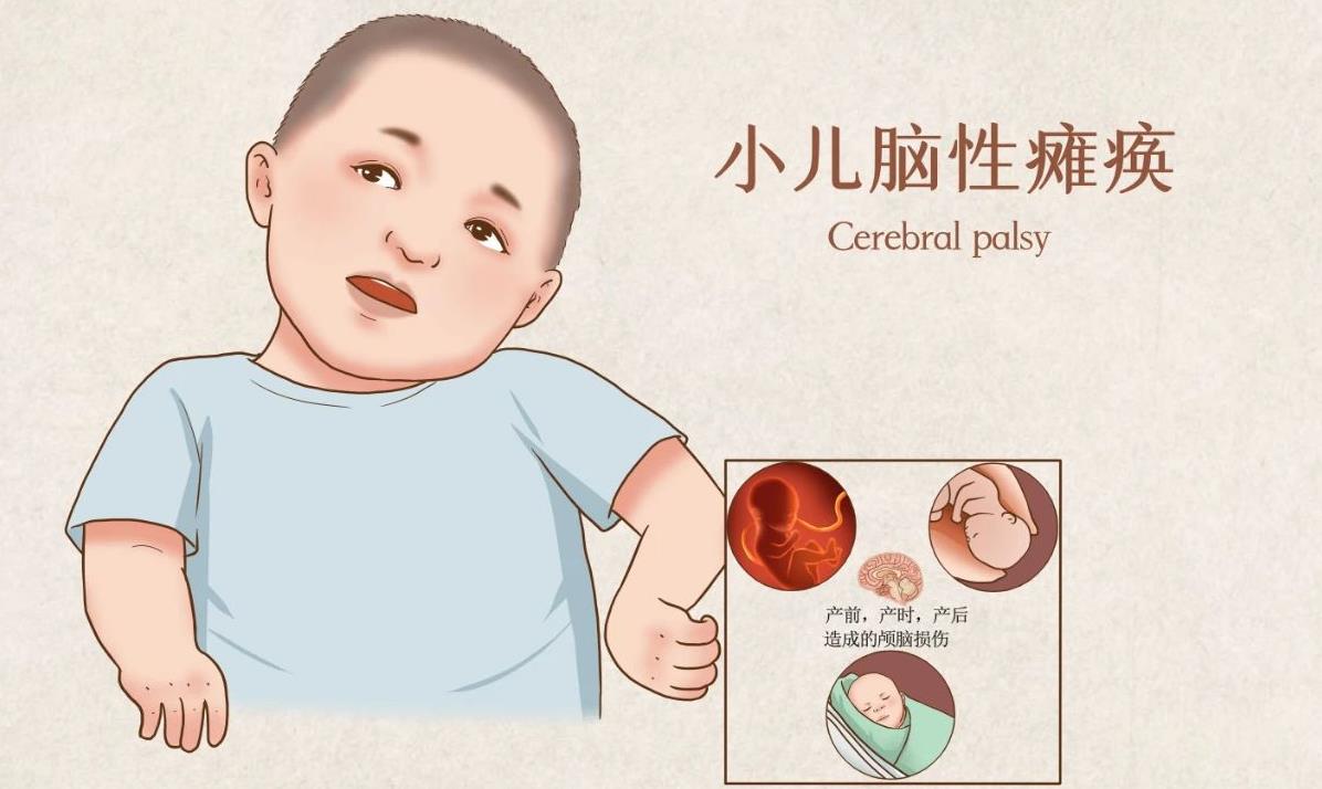 全球首次！通過鼻腔內(nèi)干細胞移植治療腦癱一項隨機1/2期對照研究