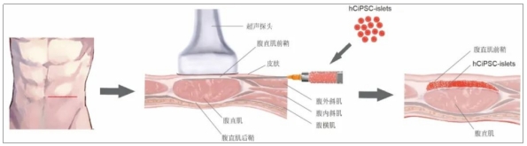 糖尿病臨床試驗(yàn)