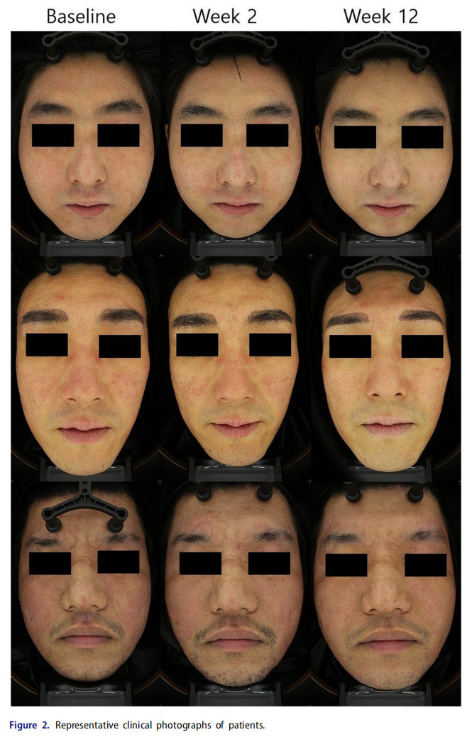 特應(yīng)性皮炎臨床試驗(yàn)