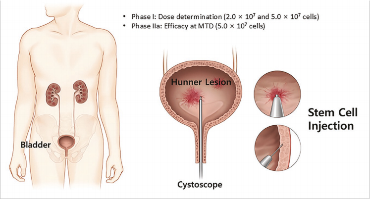 間質(zhì)性膀胱炎臨床試驗(yàn) 間質(zhì)性膀胱炎臨床試驗(yàn)
