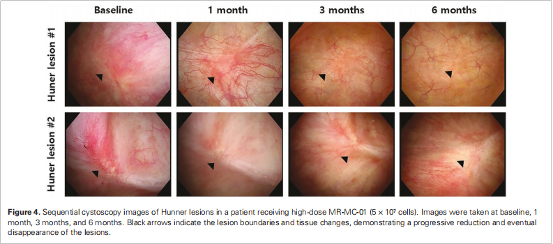 間質(zhì)性膀胱炎臨床試驗(yàn) 間質(zhì)性膀胱炎臨床試驗(yàn)