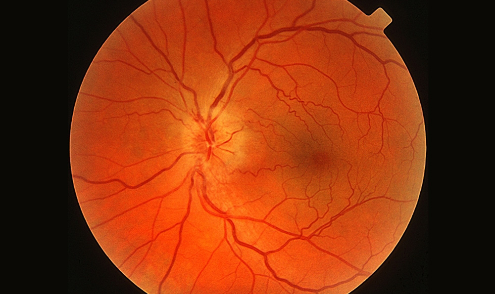 視神經(jīng)萎縮