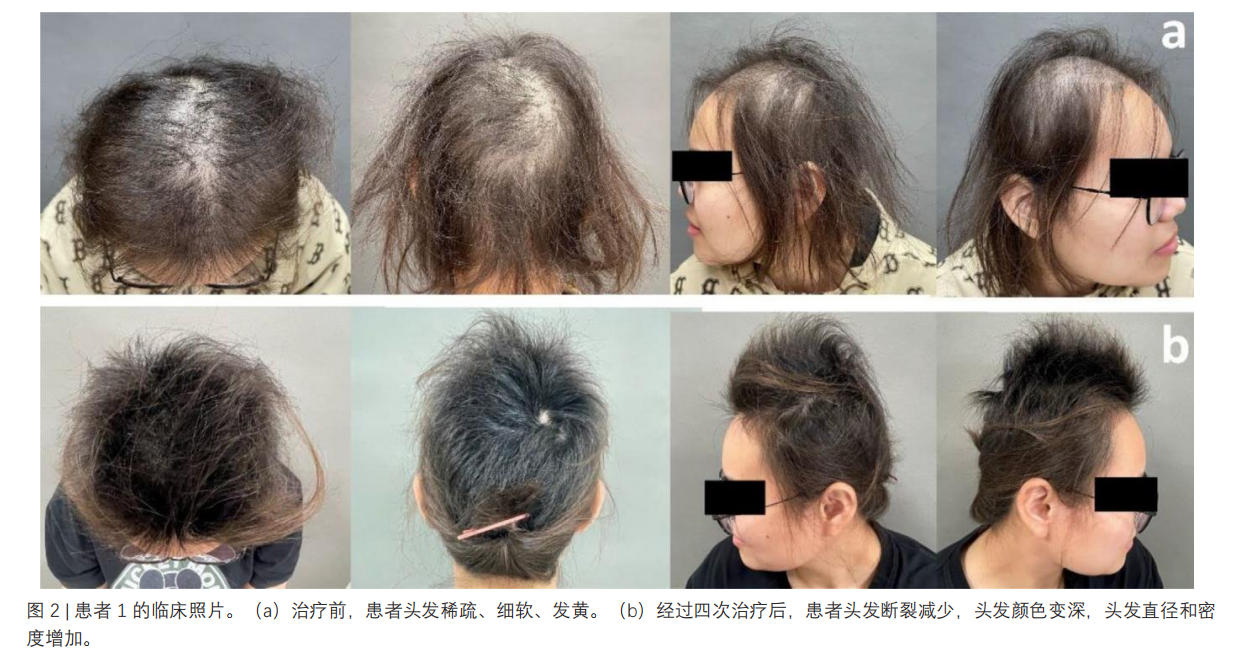 脆發(fā)癥臨床試驗(yàn)