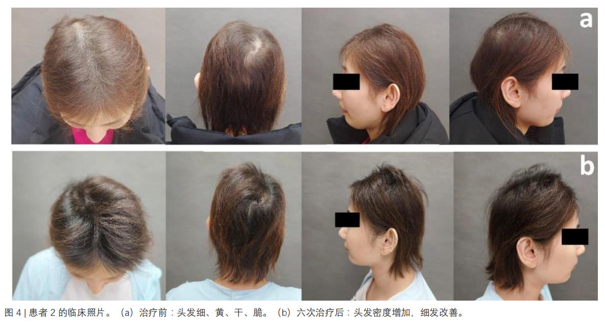 脆發(fā)癥臨床試驗(yàn)