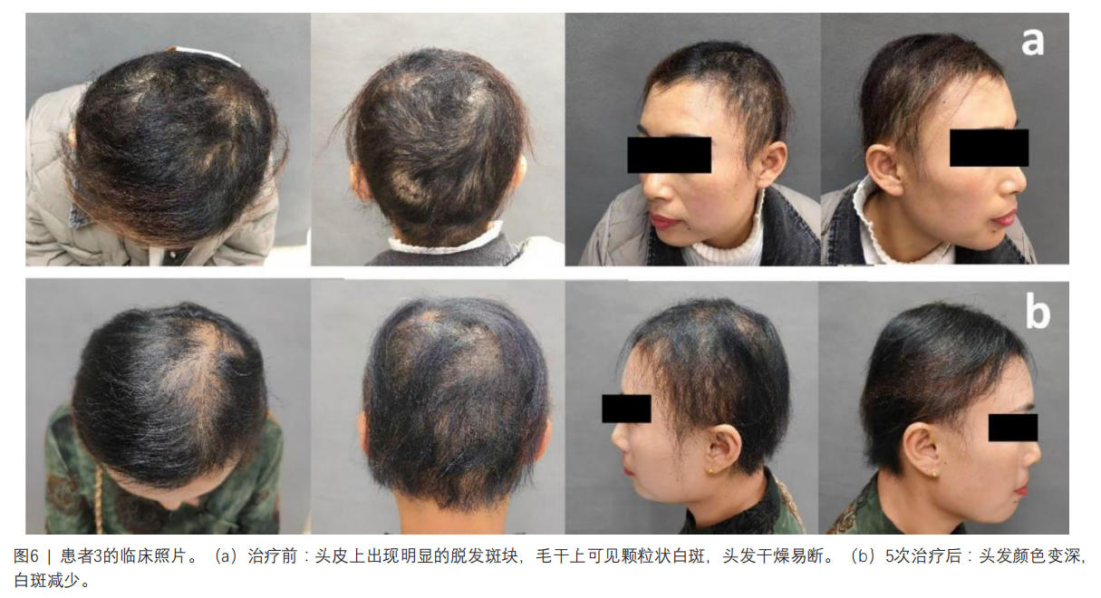脆發(fā)癥臨床試驗(yàn)