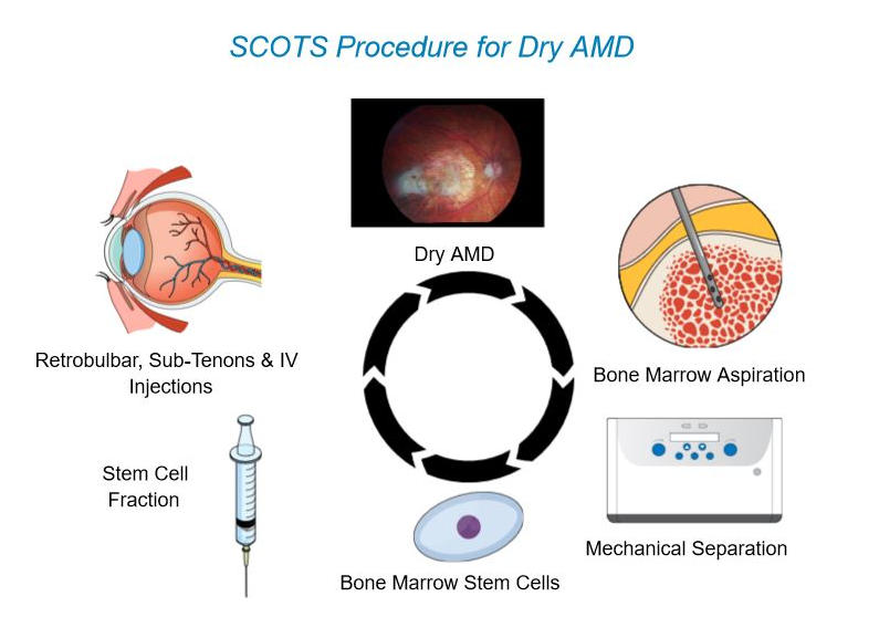 干細(xì)胞治療年齡相關(guān)黃斑變性