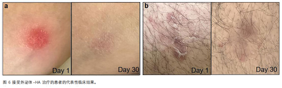 銀屑病臨床試驗(yàn)