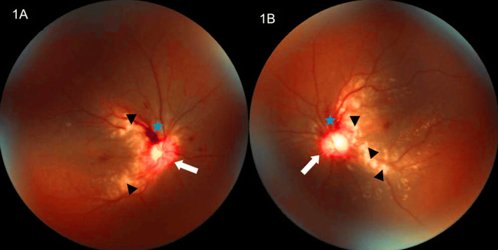 中毒性視神經(jīng)病變