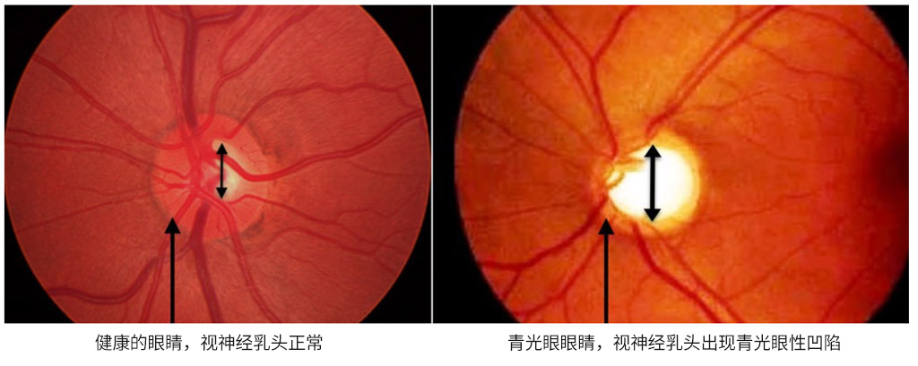 青光眼性視神經病變