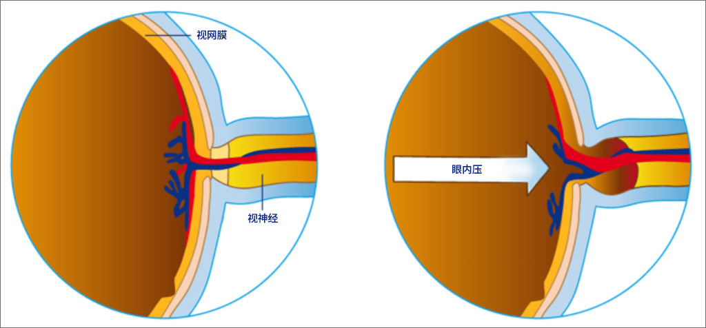 青光眼性視神經病變