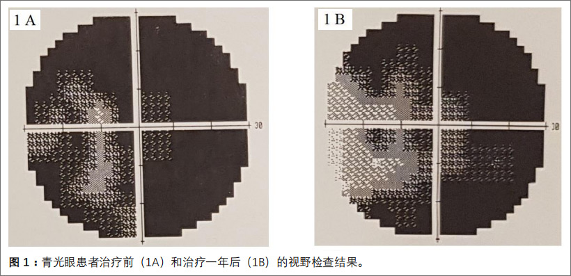 青光眼性視神經病變臨床試驗