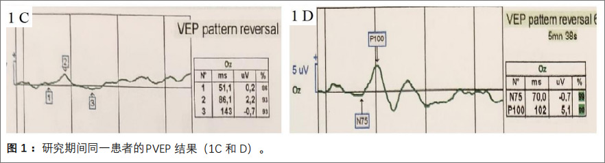 青光眼性視神經病變臨床試驗