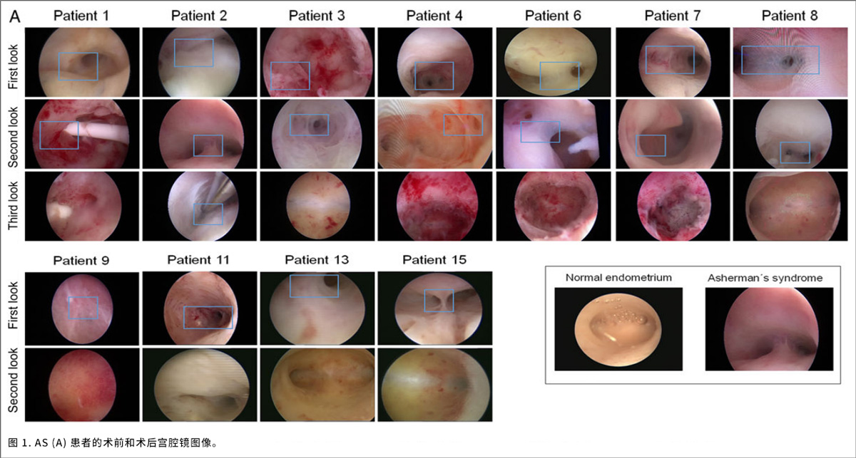 宮腔疾病臨床試驗