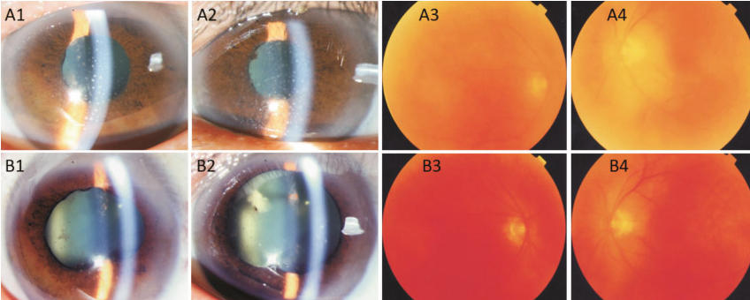 首例報道！視力提升20倍+3年無復發(fā)，干細胞或為葡萄膜炎治療帶來新希望！