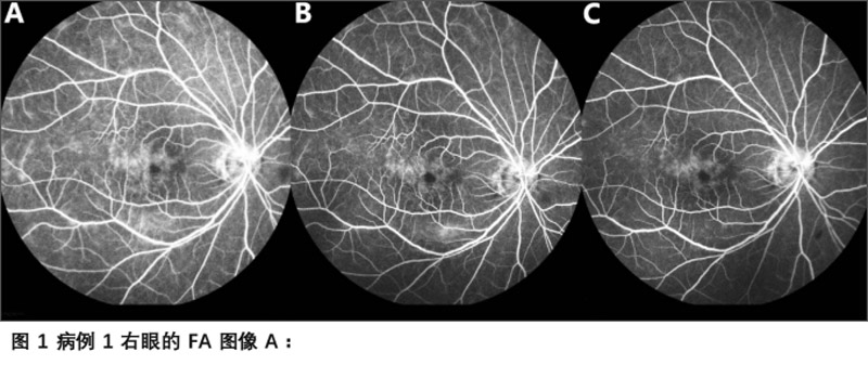 葡萄膜炎臨床試驗
